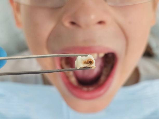 Best Emergency Treatment for Dental Infections or Abscesses in Harvey, LA